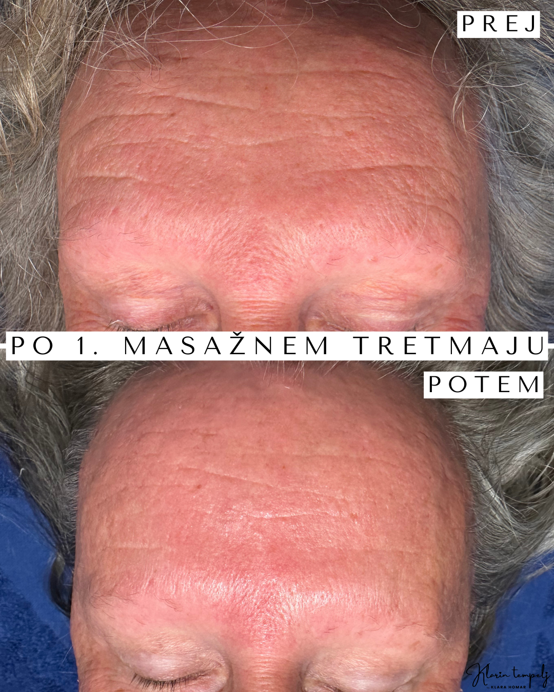 rezultat po masažnem tretmaju obraza